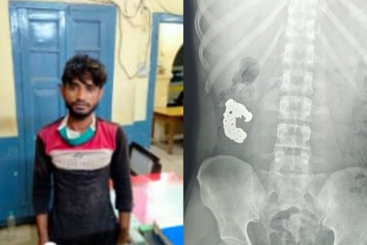 बरेली में शातिर चोर की गजब चालाकी, पुलिस को देखते ही निगल गया चांदी का ब्रेसलेट, फिर एक्सरे रिपोर्ट ने खोला राज।
