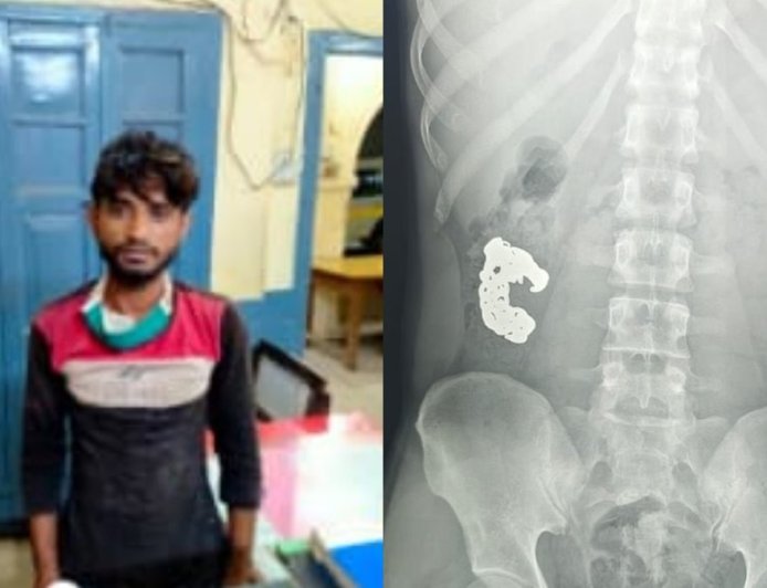 बरेली में शातिर चोर की गजब चालाकी, पुलिस को देखते ही निगल गया चांदी का ब्रेसलेट, फिर एक्सरे रिपोर्ट ने खोला राज।