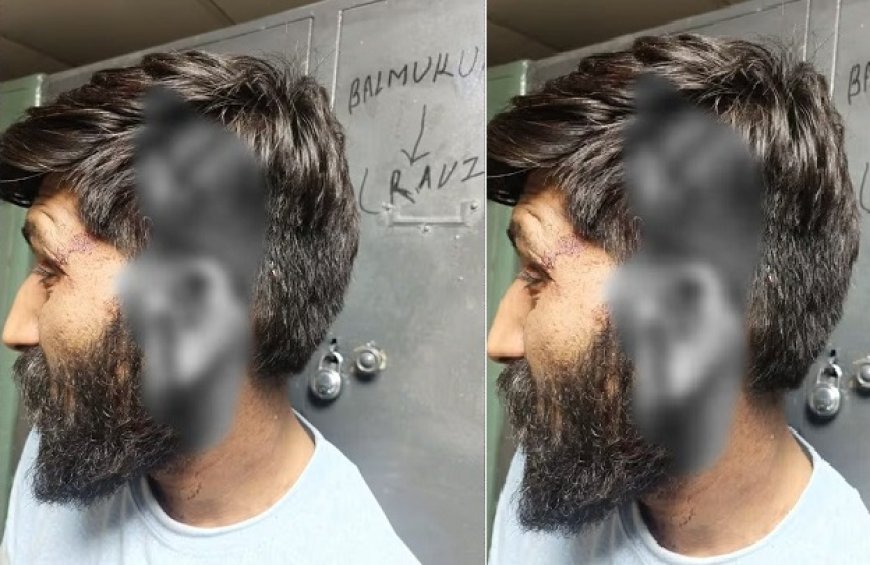 दिल्ली में मामूली बात पर खूनी संघर्ष: पेशाब करने के विवाद में दो युवकों को अधमरा होने तक पीटा, शरीर पर आए 35 टांके। 