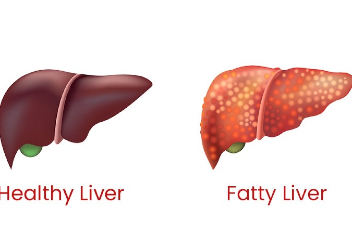 Fatty Liver Reversal: फैटी लिवर के साइलेंट लक्षणों को न करें नजरअंदाज, 14 दिनों की डाइट से ऐसे करें रिवर्स