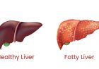 Fatty Liver Reversal: फैटी लिवर के साइलेंट लक्षणों को न करें नजरअंदाज, 14 दिनों की डाइट से ऐसे करें रिवर्स