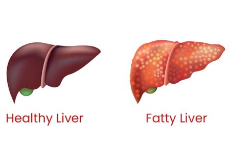Fatty Liver Reversal: फैटी लिवर के साइलेंट लक्षणों को न करें नजरअंदाज, 14 दिनों की डाइट से ऐसे करें रिवर्स