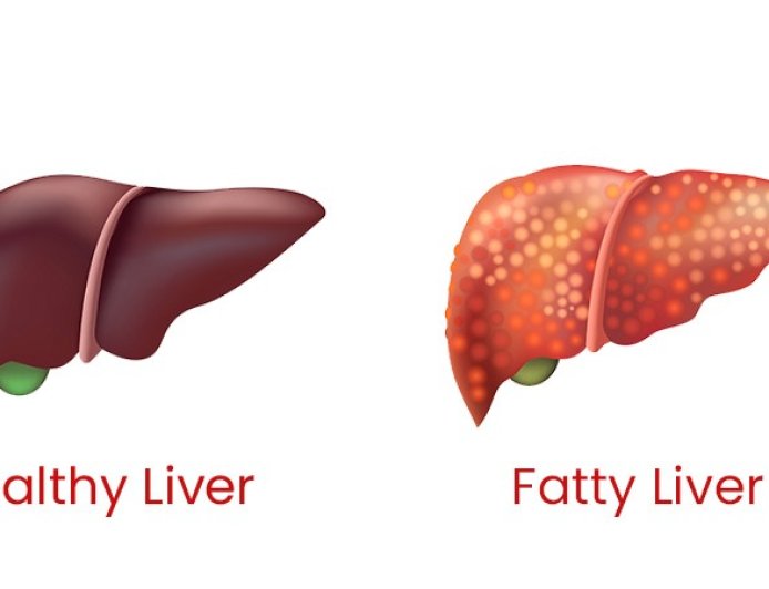 Fatty Liver Reversal: फैटी लिवर के साइलेंट लक्षणों को न करें नजरअंदाज, 14 दिनों की डाइट से ऐसे करें रिवर्स